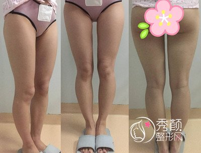 【O型腿矫正手术】脂肪填充矫正O型腿案例分享。