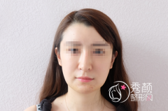 <b>【不明注射物取出】下巴取出案例分享</b>