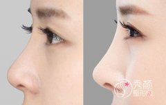 北京哪个三甲医院隆鼻好，大概需要多少钱