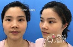 <b>上海九院韦敏磨骨手术案例。</b>