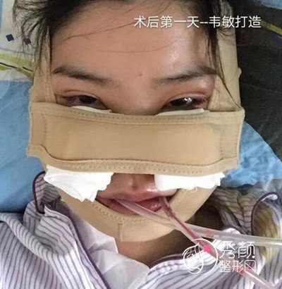 上海九院韦敏磨骨手术案例。