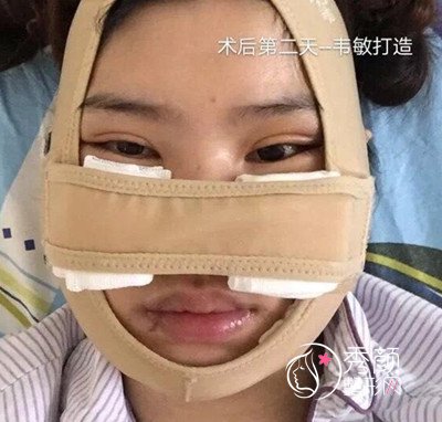 上海九院韦敏磨骨手术案例。