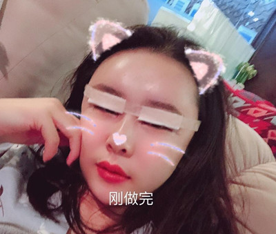 武汉禾丽整形眼部手术+全脸脂肪填充案例。