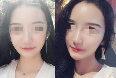 北京清木整形马梅生颧弓吸脂手术案例。