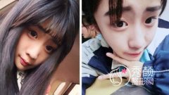 【多图】青岛诺德肋软骨鼻修复案例分享。
