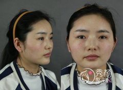 上海首尔丽格怎么样,颧骨内推果好吗？