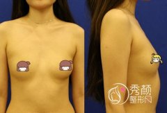 上海伊莱美隆胸怎么样,伊莱美江华隆胸案例。