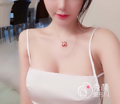 上海伊莱美隆胸怎么样,伊莱美江华隆胸案例。