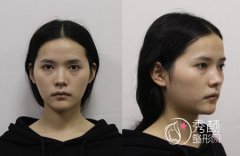 长沙华韩华美割双眼皮+全脸脂肪填充案例分享。
