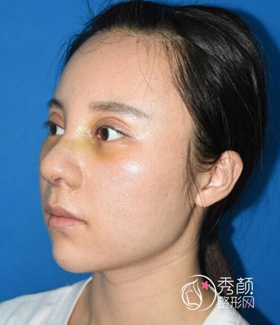 上海百达丽徐晓斐双眼皮修复+隆鼻案例。