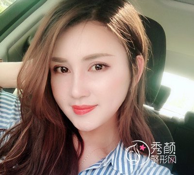 上海华美杨亚益双眼皮修复案例。