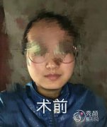 深圳盛美佳罗奇博士磨骨怎么样,靠谱吗,案例分享