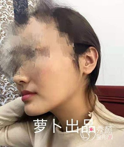 深圳盛美佳罗奇博士磨骨怎么样,靠谱吗,案例分享