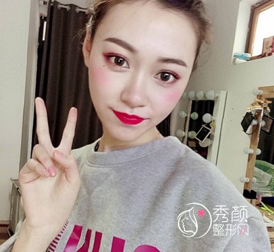 成都友谊医院张立天下颌角整形手术全过程案例