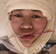 成都娇点姜宇禄下颌角磨骨案例。