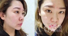 云南华美美莱隆鼻怎么样,案例图。