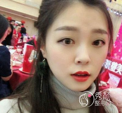 重庆磨骨谁好?华美潘宝华下颌角整形案例。