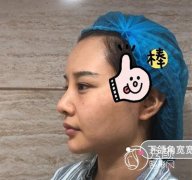 上海医生穆雄铮磨骨怎么样,案例图。