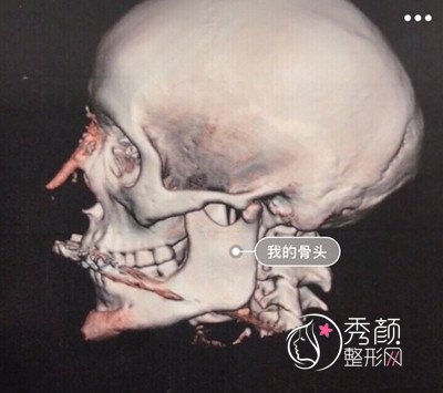 上海医生穆雄铮磨骨怎么样,案例图。