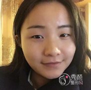 四川省人民医院游晓波割双眼皮案例。