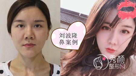 武汉刘波鼻子做得好吗,多少钱?案例图。