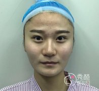 <b>上海伊莱美李湘原磨骨好吗,磨骨案例。</b>