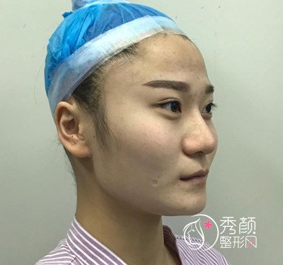 上海伊莱美李湘原磨骨好吗,磨骨案例。