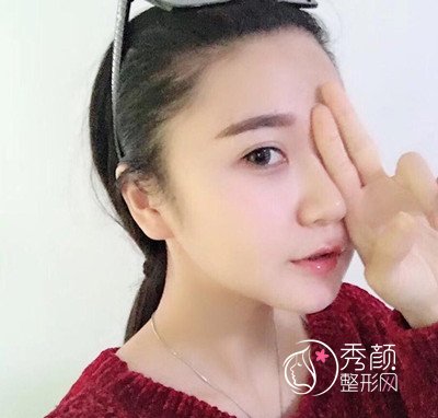 上海伊莱美李湘原磨骨好吗,磨骨案例。