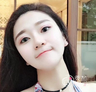 上海伊莱美李湘原磨骨好吗,磨骨案例。