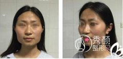 在西安西京医院做的颧弓内推和下颌角切除手术