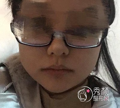 广州南方医院杜本军磨骨怎么样，附杜本军磨骨案例！