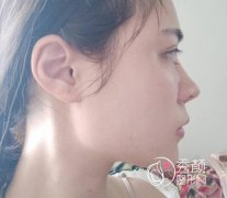 上海美联臣刘先超下颌角整形案例。