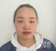 上海盈美杨璐眼部手术手术后一个月案例。