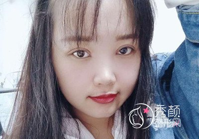 上海盈美杨璐眼部手术手术后一个月案例。