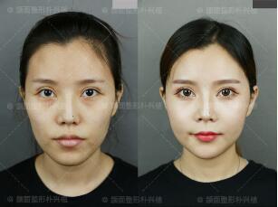 <b>洪性范下颌角手术多少钱,磨骨案例。</b>