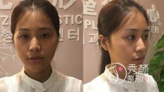 青岛诺德隆鼻怎么样,贵不贵,案例图。