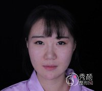 北京首玺丽格面部埋线提升案例。