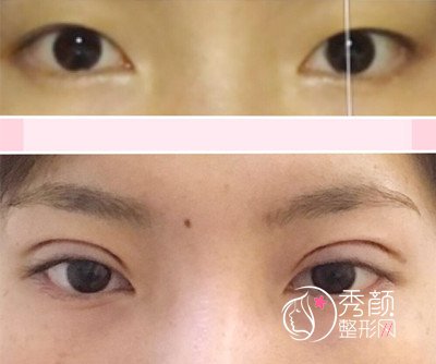 北京延士金奇龙怎么样,割双眼皮案例分享。