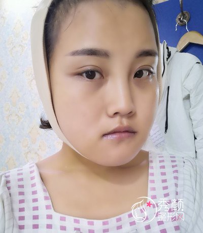 天津美莱罗金超磨骨(VLine瓜子脸)手术案例。