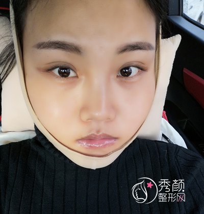 天津美莱罗金超磨骨(VLine瓜子脸)手术案例。