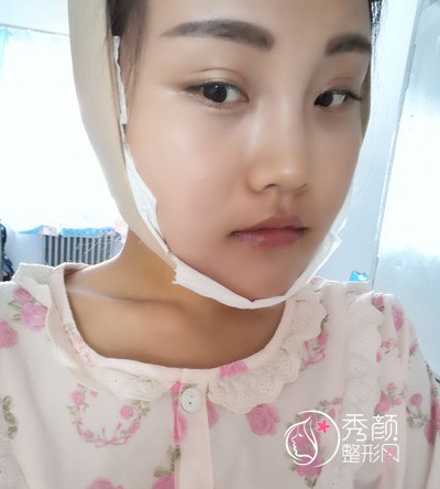 天津美莱罗金超磨骨(VLine瓜子脸)手术案例。
