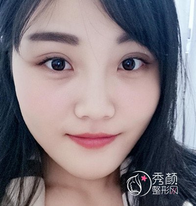 天津美莱罗金超磨骨(VLine瓜子脸)手术案例。