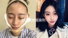 河南赵绛波下颌角整形、磨骨怎么样,价格案例分享。