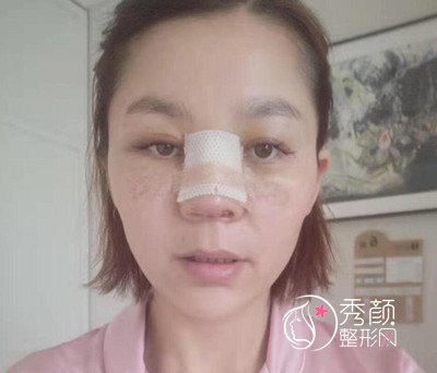 苏州紫馨顾陆健隆鼻怎么样,隆鼻前后对比案例分享。