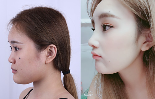 <b>上海华美李健隆鼻怎么样,贵不贵,价格案例分享。</b>