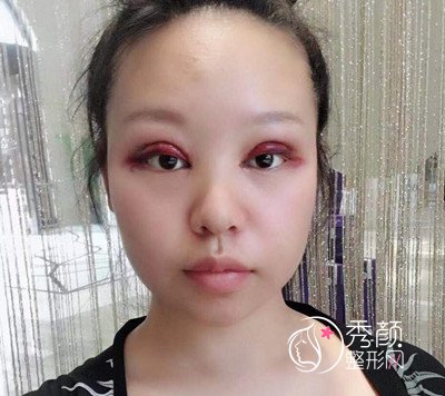 西安西京医院整形科割双眼皮+开眼角案例。