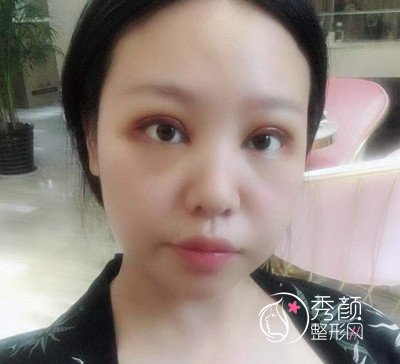 西安西京医院整形科割双眼皮+开眼角案例。
