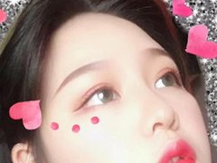 西安西京医院整形科割双眼皮+开眼角案例。