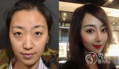 北京柏丽整形李劲良隆鼻怎么样,价格案例分享。