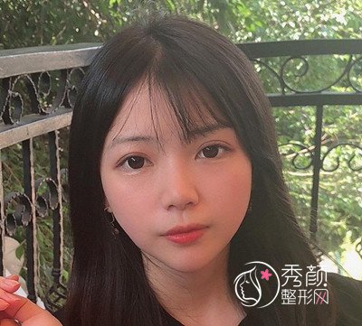 深圳恩吉娜眼部手术+隆鼻案例分享。